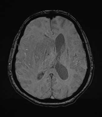 Cerebral metastasis to basal ganglia (Radiopaedia 81568-95413 Axial SWI 50).png
