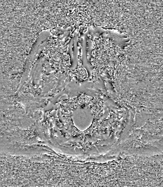 Cerebral metastasis to basal ganglia (Radiopaedia 81568-95413 Axial SWI phase 2).png