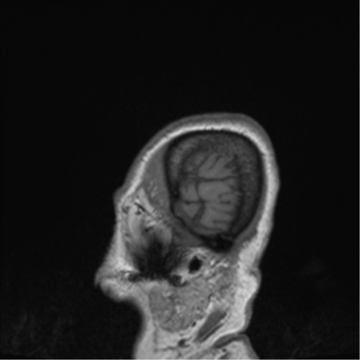Cerebral metastasis to basal ganglia (Radiopaedia 81568-95413 Sagittal T1 1).png