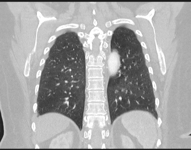 Cerebral metastasis to basal ganglia (Radiopaedia 81568-95414 Coronal lung window 65).png