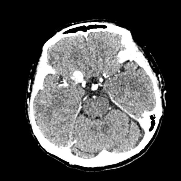 Cerebral ring enhancing lesions - cerebral metastases (Radiopaedia 44922-48818 B 103).jpg