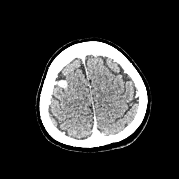 Cerebral ring enhancing lesions - cerebral metastases (Radiopaedia 44922-48818 B 242).jpg