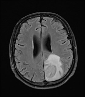 File:Cerebral toxoplasmosis (Radiopaedia 43956-47461 Axial FLAIR 15).jpg