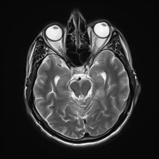 File:Cerebral toxoplasmosis (Radiopaedia 43956-47461 Axial T2 8).jpg