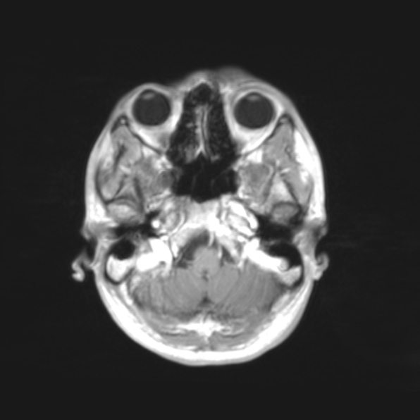 File:Cerebral toxoplasmosis (Radiopaedia 53993-61435 Axial T1 2).jpg