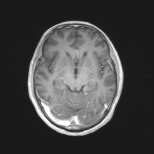 File:Cerebral toxoplasmosis (Radiopaedia 53993-61435 Axial T1 9).jpg