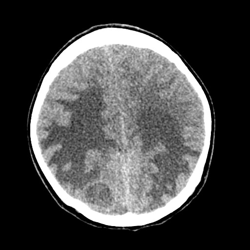 Cerebral tuberculosis with dural sinus invasion (Radiopaedia 60353-68018 Axial non-contrast 41).jpg