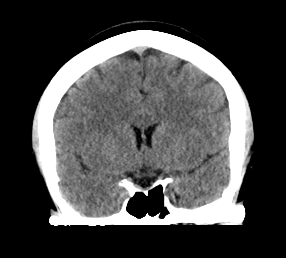 File:Cerebral venous infarct related to dural venous sinus thromboses (Radiopaedia 35292-36804 Coronal non-contrast 15).png