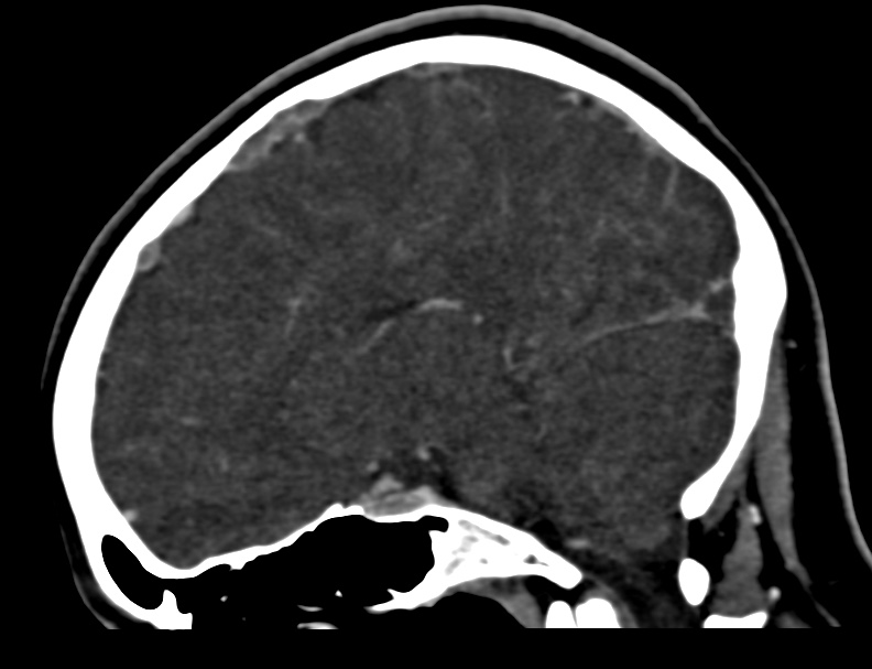 Cerebral venous sinus thrombosis (Radiopaedia 59224-66646 Sagittal C+ delayed 31).jpg