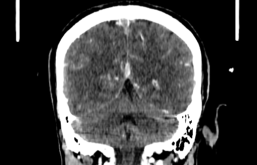 File:Cerebral venous thrombosis (CVT) (Radiopaedia 77524-89685 C 46).jpg