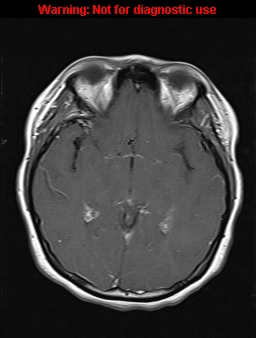 File:Cerebral venous thrombosis (Radiopaedia 37224-39208 Axial T1 C+ 10).jpg
