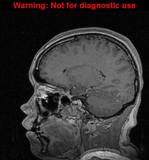 Cerebral venous thrombosis (Radiopaedia 37224-39208 Sagittal T1 C+ 59).jpg