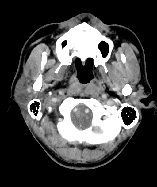 Cervical abscess (Radiopaedia 43725-47184 A 11).png