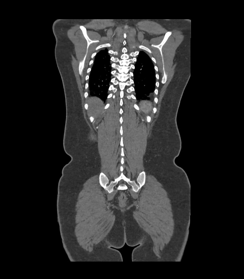Cervical aortic arch with coarctation and aneurysms (Radiopaedia 44035-47552 C 6).jpg