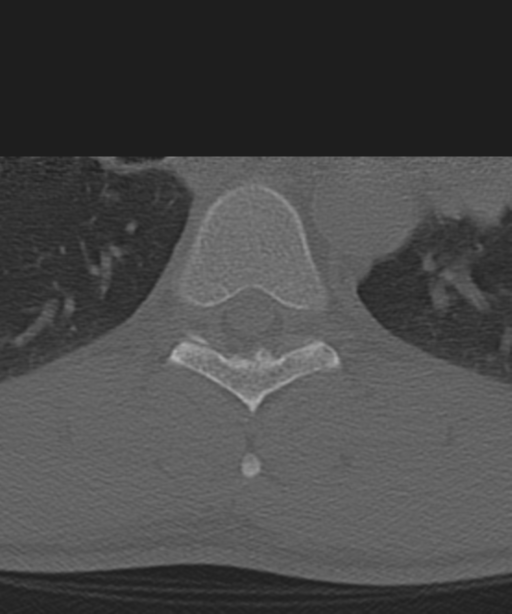 Cervical intercalary bone (Radiopaedia 35211-36748 Axial bone window 91).png