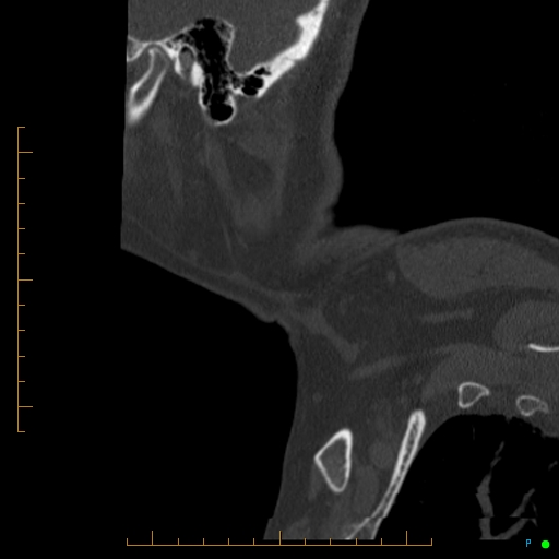 Cervical spine fracture - ankylosing spondylitis (Radiopaedia 76835-88706 Sagittal bone window 115).jpg