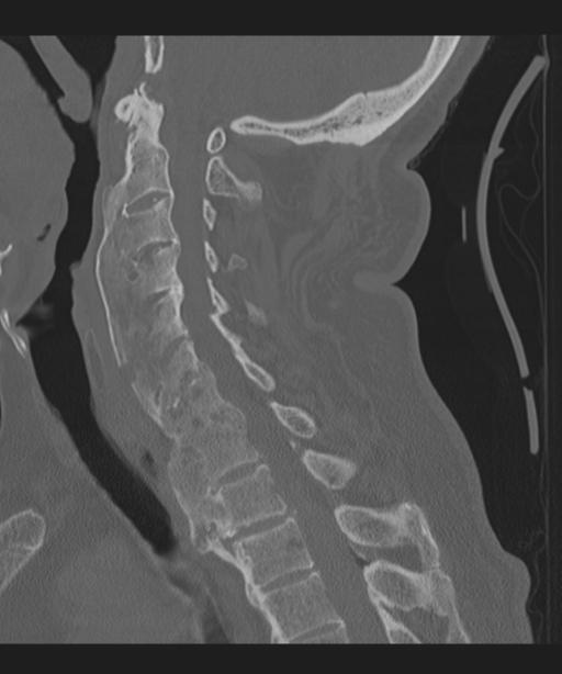 Cervical spine fracture in the setting of ankylosis (Radiopaedia 37038-38715 Sagittal bone window 43).png
