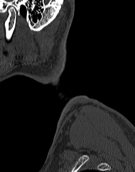 Cervical spondylodiscitis (Radiopaedia 28057-29489 Sagittal bone window 3).jpg