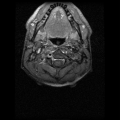 File:Cervical vertebrae metastasis (Radiopaedia 78814-91667 Axial T1 C+ fat sat 7).png