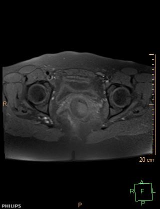 File:Cesarian scar endometriosis (Radiopaedia 68495-78066 Axial T1 fat sat 18).jpg