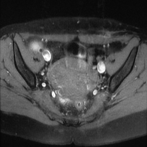 File:Cesarian section scar endometriosis (Radiopaedia 66520-75799 Axial T1 fat sat 11).jpg