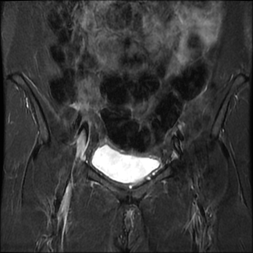 File:Cesarian section scar endometriosis (Radiopaedia 66520-75799 Coronal STIR 10).jpg