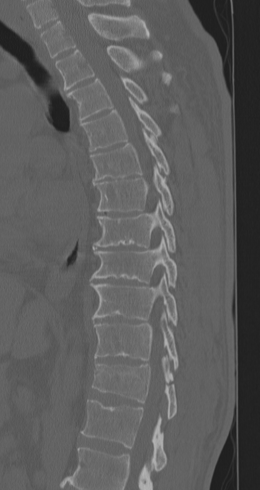 Chance fracture (Radiopaedia 33854-35020 Sagittal bone window 48).png