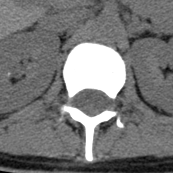 File:Chance fracture (Radiopaedia 36521-38081 Axial non-contrast 70).jpg