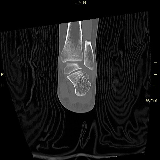 Chaput tubercle fracture (Radiopaedia 80319-93956 Coronal non-contrast 45).jpg