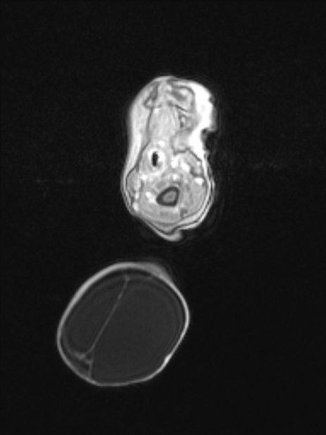 Chiari III malformation with occipital encephalocele (Radiopaedia 79446-92559 Axial T1 C+ mpr 18).jpg
