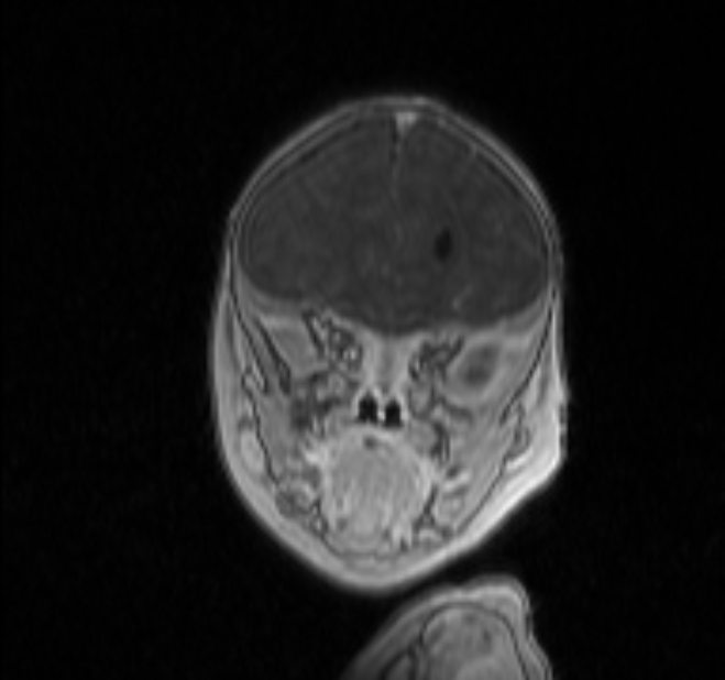 Chiari III malformation with occipital encephalocele (Radiopaedia 79446-92559 Coronal T1 C+ mpr 1).jpg