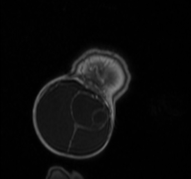 Chiari III malformation with occipital encephalocele (Radiopaedia 79446-92559 Coronal T1 C+ mpr 52).jpg