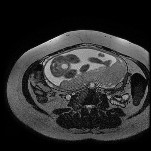 Chiari II malformation - fetal MRI (Radiopaedia 68099-77581 Axial Fiesta 7).jpg