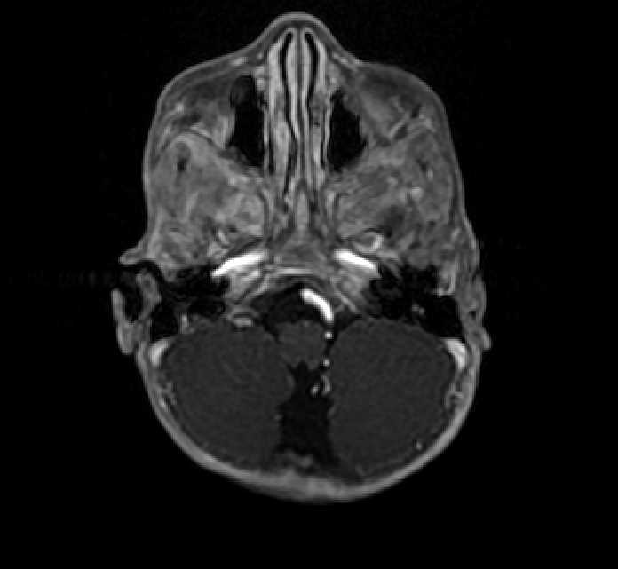 Chiasmatic-hypothalamic glioma (Radiopaedia 90079-107252 Axial T1 C+ 11).jpg