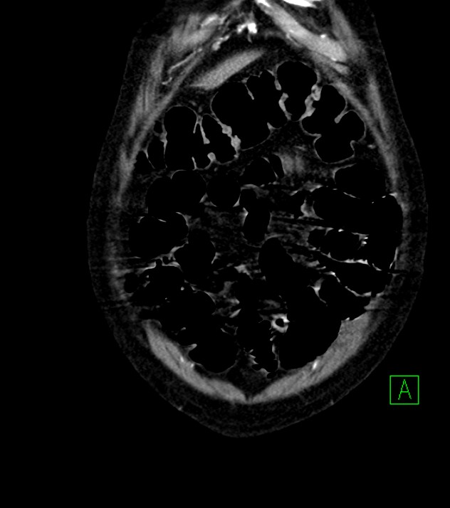Cholangiocarcinoma with cerebral metastases (Radiopaedia 83519-98629 E 14).jpg