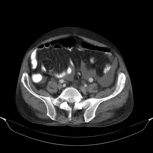 File:Cholangitis and abscess formation in a patient with cholangiocarcinoma (Radiopaedia 21194-21100 A 37).jpg