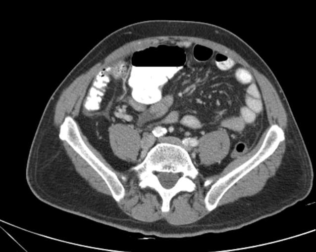 File:Cholecystitis - perforated gallbladder (Radiopaedia 57038-63916 A 57).jpg
