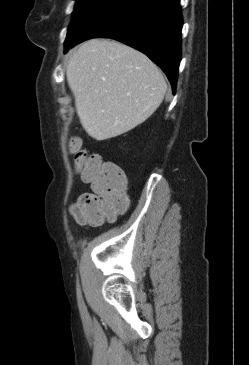 Cholecystoduodenal fistula due to calculous cholecystitis with gallstone migration (Radiopaedia 86875-103077 F 50).jpg