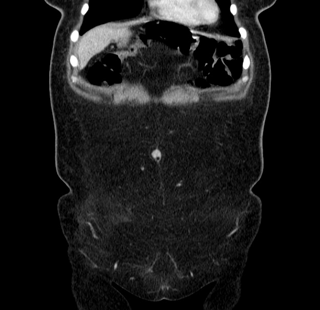Choledocholithiasis on CT and MRI (Radiopaedia 24825-25087 C 9).jpg
