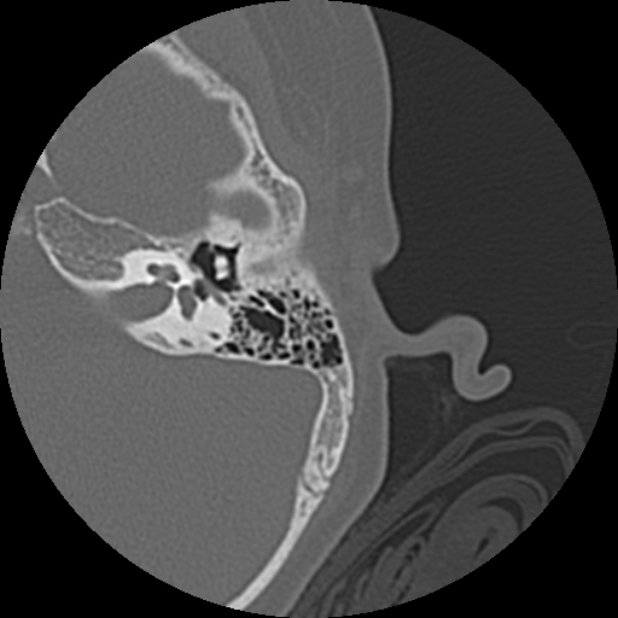 Cholesteatoma (Radiopaedia 73023-83750 Axial Left ear 42).jpg