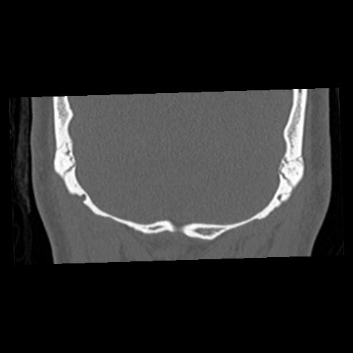 Cholesteatoma (Radiopaedia 84960-100474 Coronal bone window 71).jpg