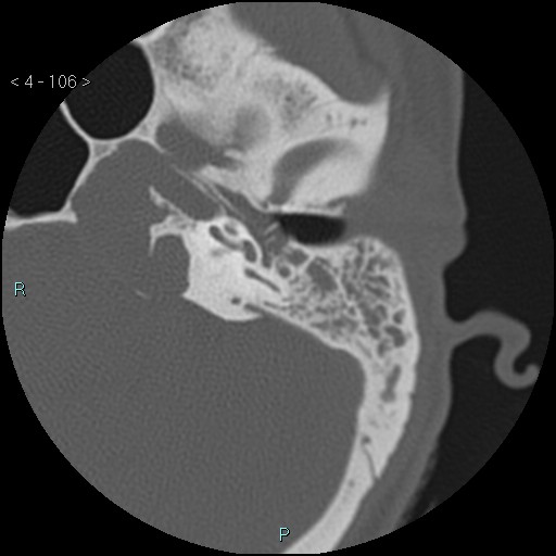 File:Cholesterol granuloma of the petrous apex (Radiopaedia 64358-73141 Axial bone window 51).jpg