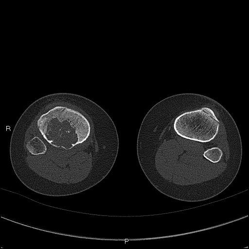 Chondroblastoma (Radiopaedia 62721-71030 Axial bone window 75).jpg