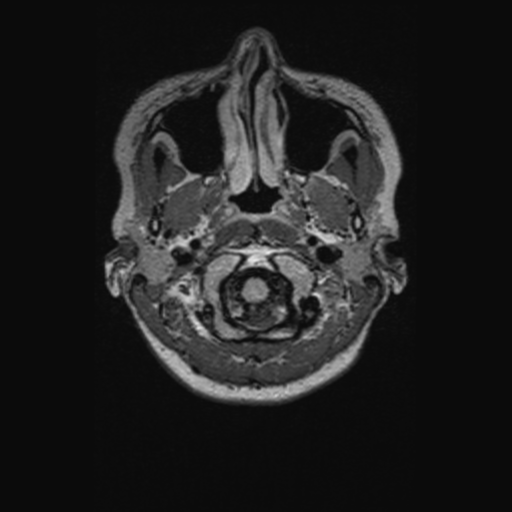 Chondrosarcoma (Radiopaedia 41937-44939 Axial FLAIR 10).png