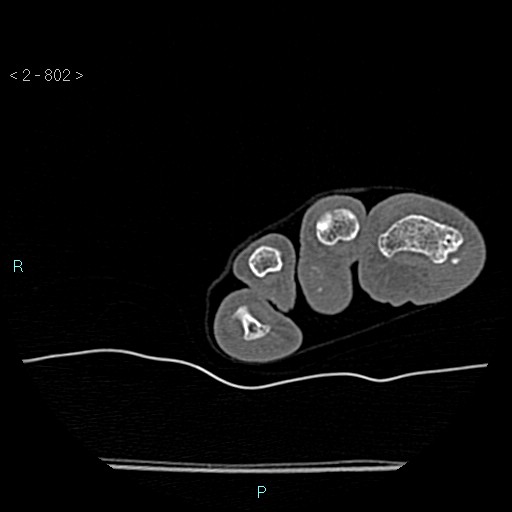 Chondrosarcoma - phalanx (Radiopaedia 69047-78812 Axial bone window 56).jpg
