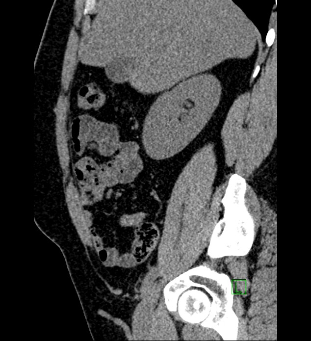 Chromophobe renal cell carcinoma (Radiopaedia 84286-99573 C 132).jpg