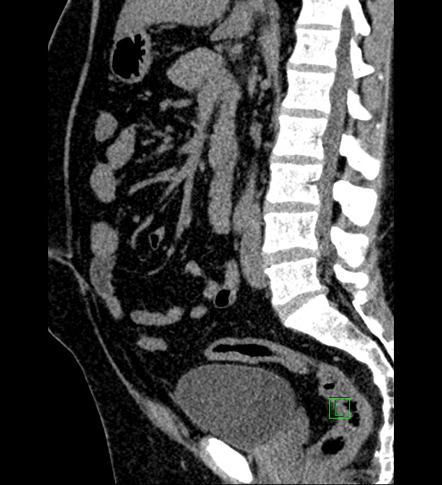 Chromophobe renal cell carcinoma (Radiopaedia 84286-99573 C 90).jpg