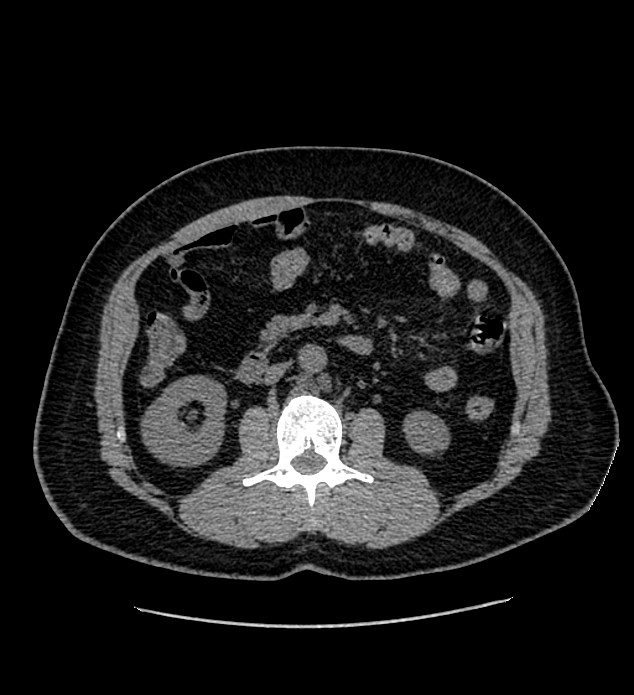 Chromophobe renal cell carcinoma (Radiopaedia 84337-99693 Axial non-contrast 62).jpg