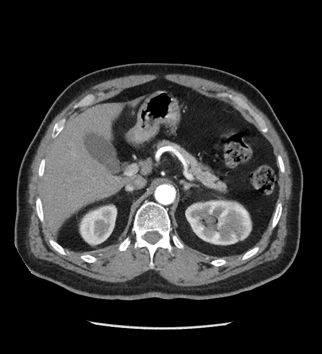Chromophobe renal cell carcinoma (Radiopaedia 86879-103083 B 41).jpg