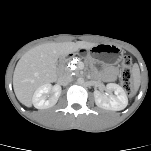 File:Chronic calcific pancreatitis (Radiopaedia 56280-62953 C 17).jpg